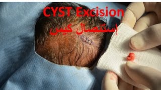 Excision of a Cyst over Scalp إستئصال كيس من فروة الرأس [upl. by Stephana794]