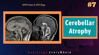 Causes for Cerebellar Atrophy  Radiology tutorials  1000 cases in 100 days  Video 7 [upl. by Aikaz]