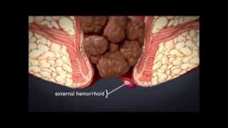 HEMORRHOiDS  What are hemorrhoids  What is the treatment for hemorrhoids [upl. by Nahama]