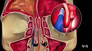 NonInvasive Procedure Is Proving Successful in Sinusitis Treatment [upl. by Lynelle]