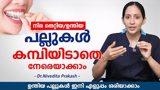 ഉന്തിയ പല്ലുകൾ ഇനി എളുപ്പം നേരയാകാം കമ്പിയിടാതെ  Clear Aligners for Teeth  Elite Dental Studio [upl. by Enirbas]