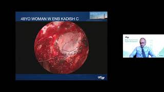 Surgical Management of Meningiomas and Other Skull Base Tumors  Philip Theodosopoulos MD [upl. by Ahsym420]