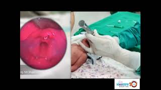 Less Invasive Surfactant Administration LISA technique for Pediatricians amp Neonatologists [upl. by Mandie]