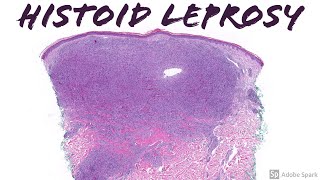 quotHistoidquot Lepromatous Leprosy Hansen disease [upl. by Elleyoj746]