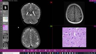 DISPLASIA CORTICAL FOCAL TIPO II B [upl. by Deena]