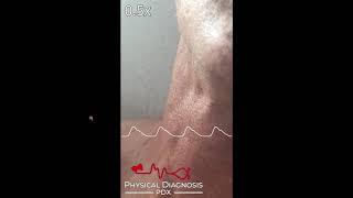 Jugular Venous Pulse Identification [upl. by Lyon]