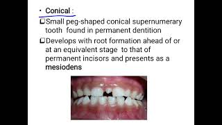 supernumerary teeth [upl. by Jacinda170]