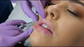 Lip Fillers  what to expect during the procedure  The Laser amp Skin Clinic [upl. by Nref]