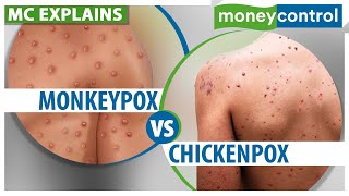 Monkeypox How Is It Different From Chickenpox  Explained [upl. by Brinna]