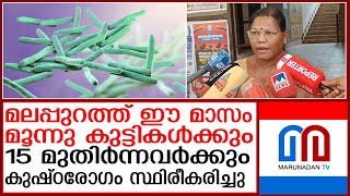 മൂന്നു കുട്ടികള്‍ക്കും15 മുതിര്‍ന്നവര്‍ക്കും കുഷ്ഠരോഗം സ്ഥിരീകരിച്ചു I Leprosy [upl. by Grodin]