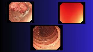 Gastric giant polyp  Todua Clinic [upl. by Novi]