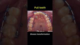 Braces change your teeth for better braces orthodontist dentist [upl. by Nrev424]