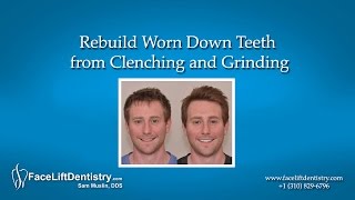 Rebuild Worn Down Teeth from Clenching and Grinding [upl. by Rraval642]