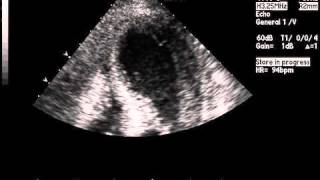 Transthoracic Echocardiogram Showing Akinesis on Apical FourChamber View [upl. by Edmon]