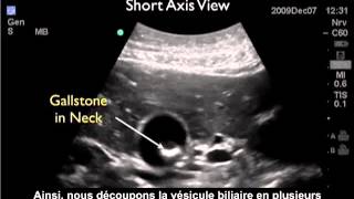 Comment  Réaliser une échographie de la vésicule biliaire  Partie 2  Calculs biliaires [upl. by Santos671]