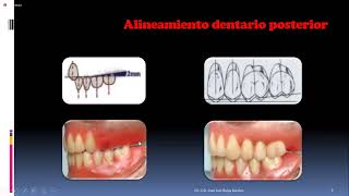 PRÓTESIS TOTAL ENFILADO o ARTICULADO DE DIENTES SUPERIORES [upl. by Nivak]