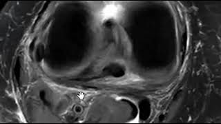 Plantaris muscle tear [upl. by Nirhtak753]