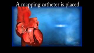 Ventricular Tachycardia VT Ablation [upl. by Nnahgem]