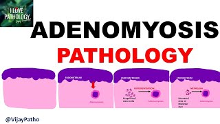 ADENOMYOSIS  Pathology Clinical Features Diagnosis amp treatment [upl. by Yrehc703]