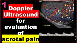 Color Doppler Ultrasound for evaluation of scrotal pain part 1 [upl. by Enair110]