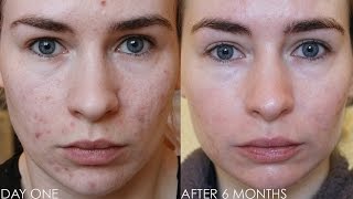 ROACCUTANE MONTH 6  Update amp Daily Skin Vlog [upl. by Aldos]