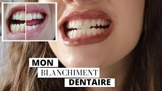 BLANCHIMENT DENTAIRE  chez le dentiste  prix durée etc JE VOUS DIS TOUT [upl. by Notfilc35]