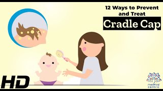 Cradle Cap Solutions 12 Effective Ways to Prevent and Treat It [upl. by Ymor]