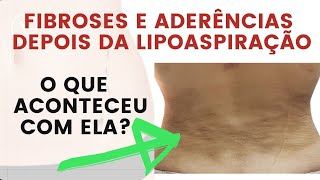 Tratamento para Fibroses e Aderências depois da lipoaspiração entenda o que aconteceu com ela [upl. by Bashee309]