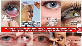 DRY EYE SYNDROME  हिंदी में  HINDI  Education amp Information Causes  Symptoms  Treatment [upl. by Nirda]