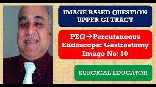 PERCUTANEOUS ENDOSCOPIC GASTROSTOMY UPPER GI TRACT Image Based Question [upl. by Haroppiz356]