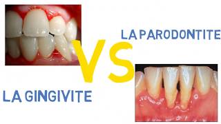 Gingivite VS parodontite [upl. by Nafri227]