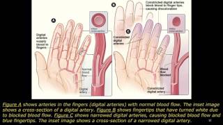 raynauds disease [upl. by Manny]