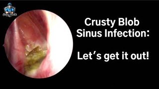 Crusty Blob Sinus Infection Lets Get It Out [upl. by Eseer]