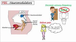 Painful Bladder Syndrome PBS  Interstitial Cystitis IC [upl. by Ellecram954]