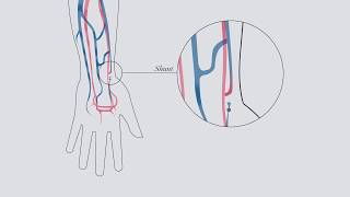 Understanding hemodialysis [upl. by Anwahs]