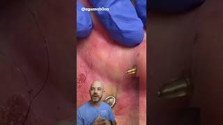 This is an iconic ear cyst extraction 👂credit aguanab0ca on TT doctor satisfying viral [upl. by Rance]