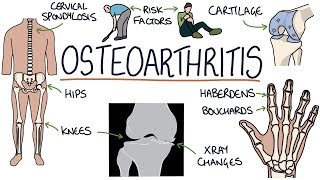 Understanding Osteoarthritis [upl. by Baseler]