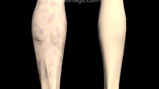 Deep Venous Thrombosis DVT Signs and Symptoms Animation by Cal Shipley MD [upl. by Fitton]