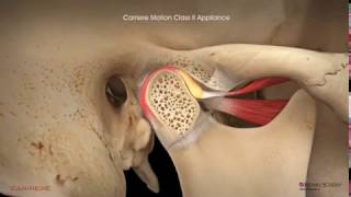 Carriere® Motion Clear™ Appliance with Clear Aligners Patient Education Animation [upl. by Paget419]