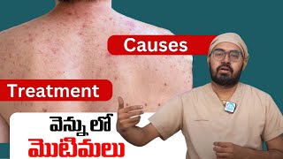 Back acne  Why does it happen  How to treat  Dermatologist suggestions  Cosmo venkatesh [upl. by Decima]