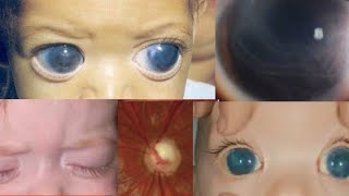 PRIMARY CONGENITAL GLAUCOMA  buphthalmos megalocornea haabs striae cupping and more [upl. by Alegnaoj626]