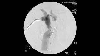 Management of CV Stenosis Endovascular vs Surgical Debate ASDIN 2023 [upl. by Gentes]