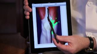 Minimally Invasive Knee Replacement and the Quadriceps Tendon [upl. by Dwayne]