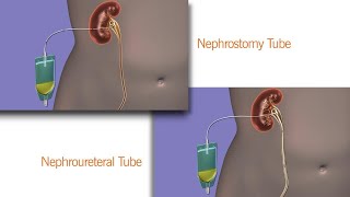 Your Nephrostomy or Nephroureteral Drain [upl. by Acinet]