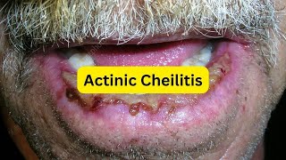 What is actinic cheilitis EASY [upl. by Audras]