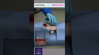 Arterial line insertion shorts [upl. by Lebama]