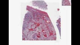 Histopathology Brain cerebellum Medulloblastoma [upl. by Imugem]