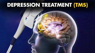 How Transcranial Magnetic Stimulation TMS Is Performed To Treat Depression [upl. by Coffin]