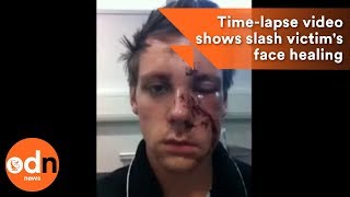 Incredible selfie timelapse video shows slash victims face healing [upl. by Nilyad]