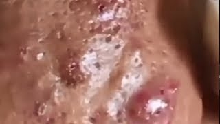 LARGE Blackheads Removal  Satisfying Blackhead 2019 Part 06 [upl. by Nonnag]